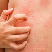 Skin Irritation