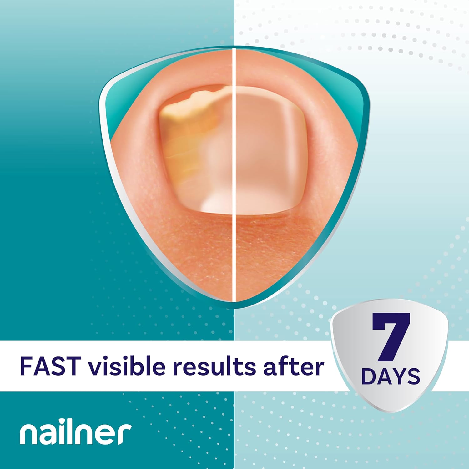 Nailner Fungal Nail Treatment Pen 4 ml - Extra Strong Anti Fungal Nail Treatment for Toenails