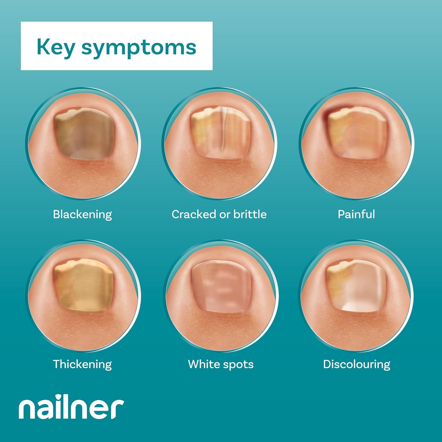 Nailner Fungal Nail Treatment Pen 4 ml - Extra Strong Anti Fungal Nail Treatment for Toenails
