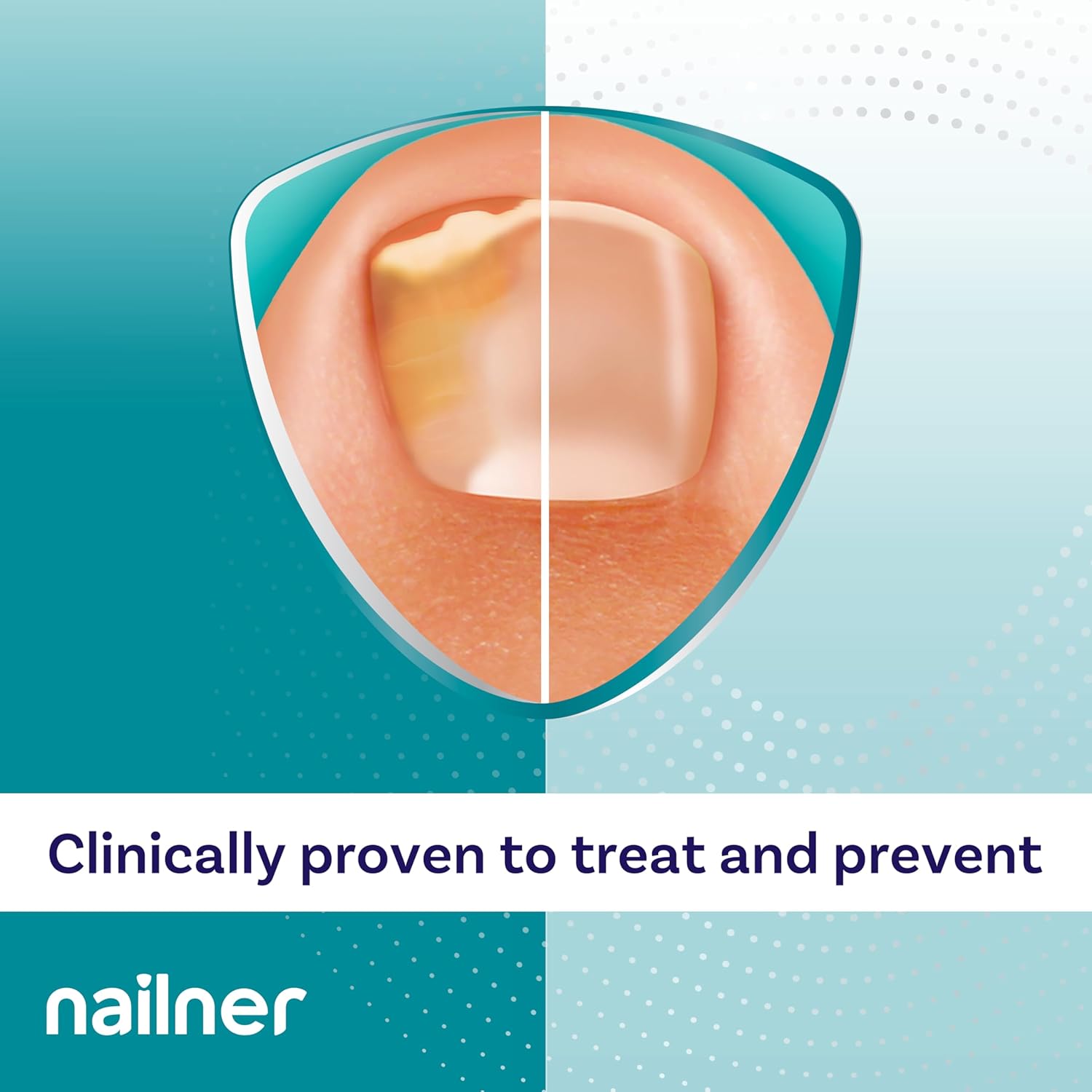 Nailner Anti Fungal Nail Treatment Brush for Toenails 5 ml - 300 Applications