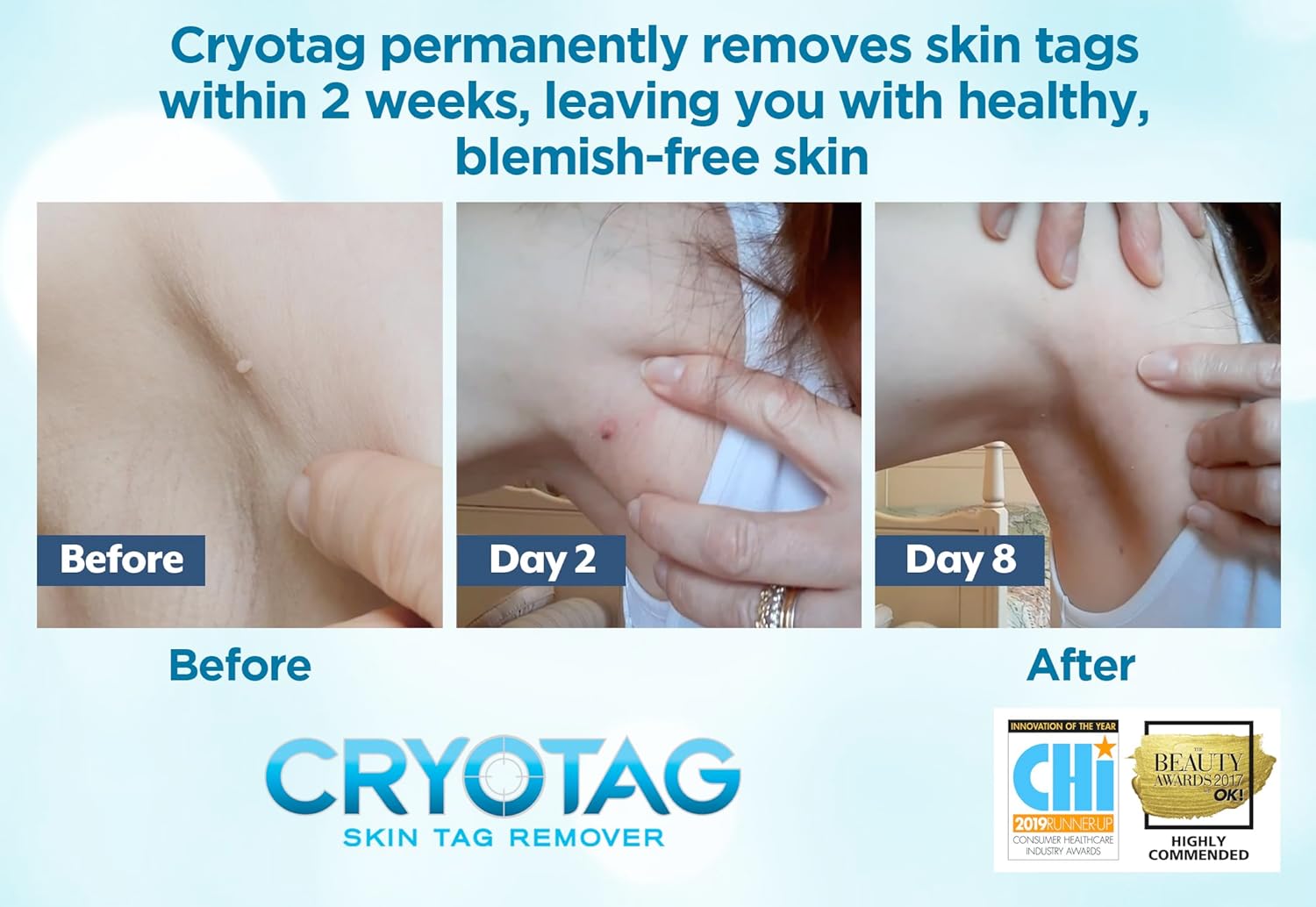 Cryotag Skin Tag Remover Fast Effective Safe Skin Tag Removal | Up to 12 treatments